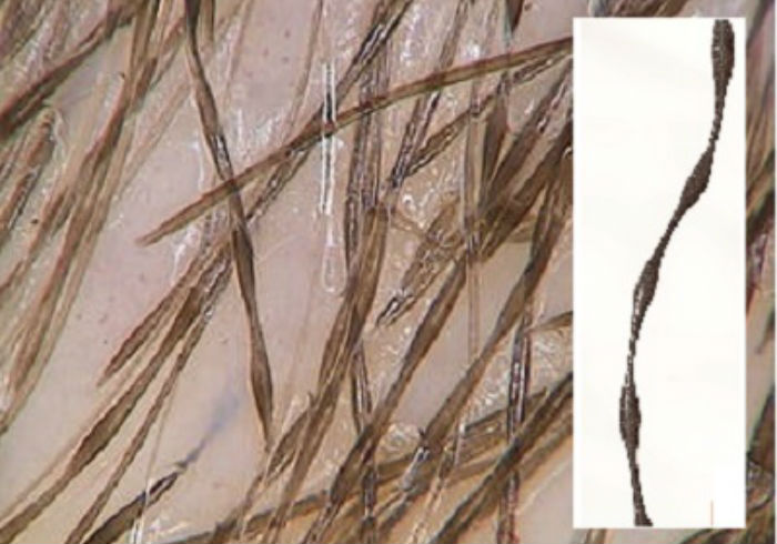 Monilethrix eOtazky.cz